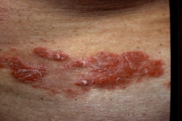 Mycosis Fungoides (37)
