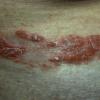 Mycosis Fungoides (38)