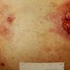 Mycosis Fungoides (39)