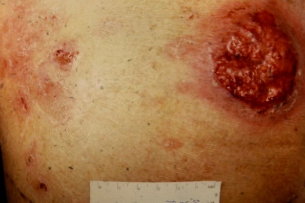 Mycosis Fungoides (39)