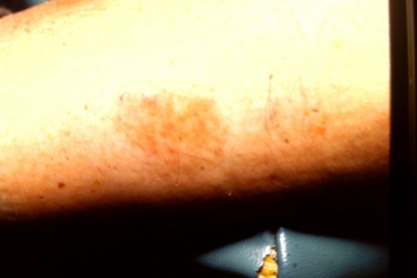 Mycosis Fungoides (4)