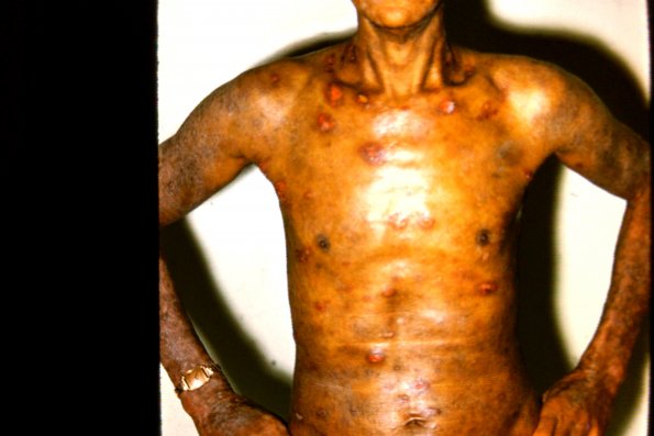 Mycosis Fungoides (41)