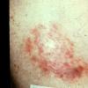 Mycosis Fungoides (42)