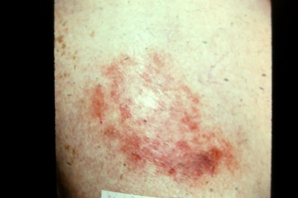 Mycosis Fungoides (42)