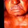 Mycosis Fungoides (43)