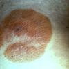 Mycosis Fungoides (45)
