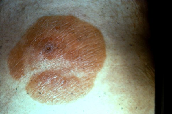 Mycosis Fungoides (45)