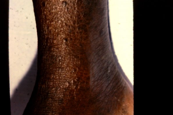 Mycosis Fungoides (48)
