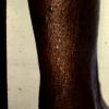 Mycosis Fungoides (49)