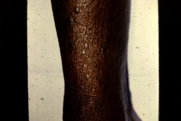 Mycosis Fungoides (49)