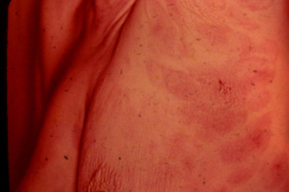 Mycosis Fungoides (50)