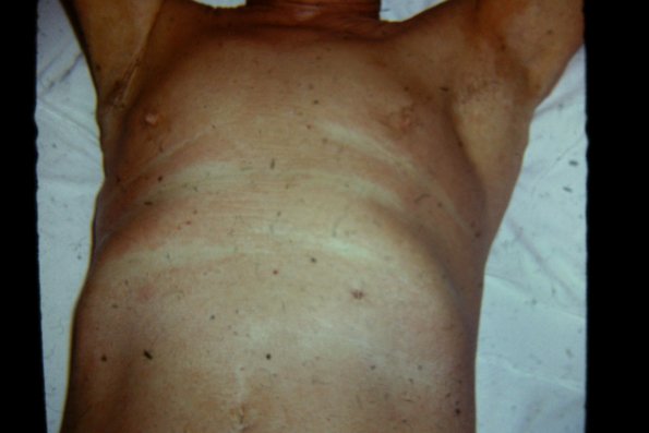 Mycosis Fungoides (52)