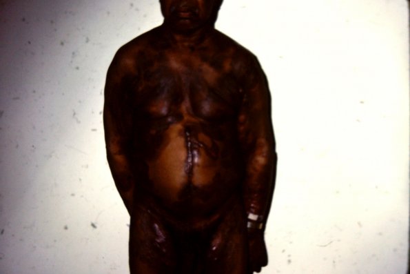 Mycosis Fungoides (53)