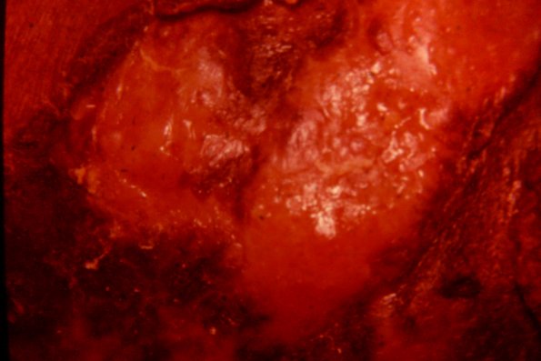 Mycosis Fungoides (55)
