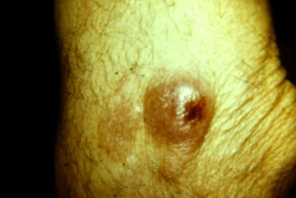 Mycosis Fungoides (59)