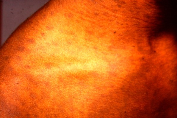 Mycosis Fungoides (6)