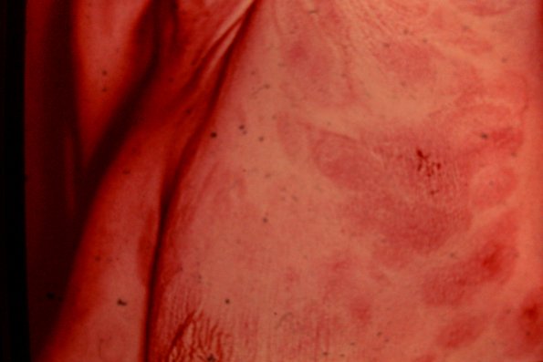 Mycosis Fungoides (60)