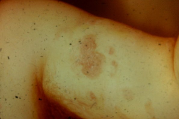 Mycosis Fungoides (61)
