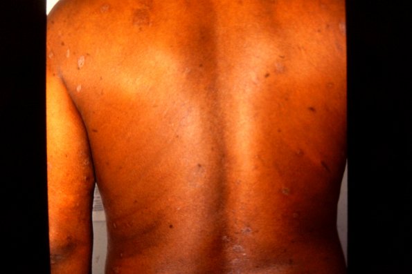 Mycosis Fungoides (7)