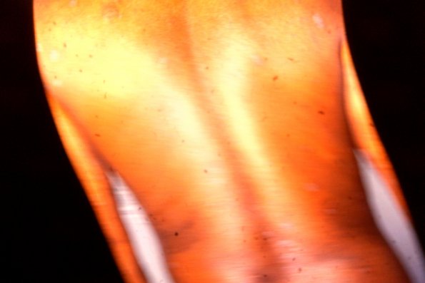 Mycosis Fungoides (8)