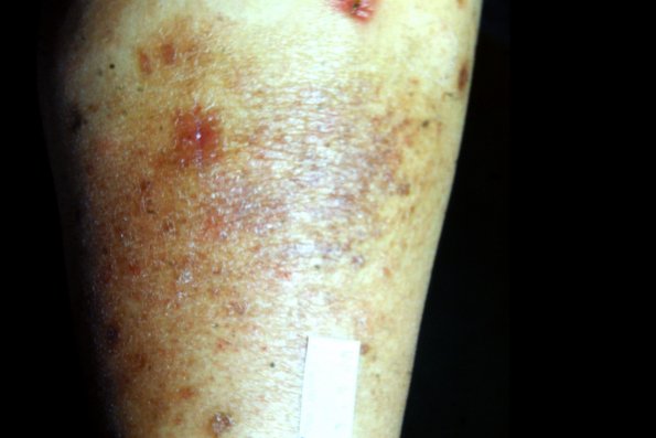 Mycosis Fungoides (9)