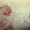 Psoriasiform Mycosis Fungoides