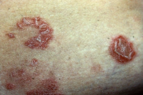 Psoriasiform Mycosis Fungoides