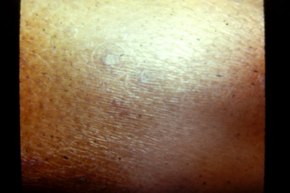 Ichthyosis Myxedema