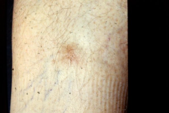 Myxedema (2)