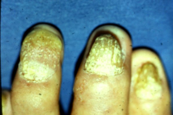 Nail Psoriasis (44)