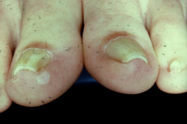 Pincer Nail Dystrophy