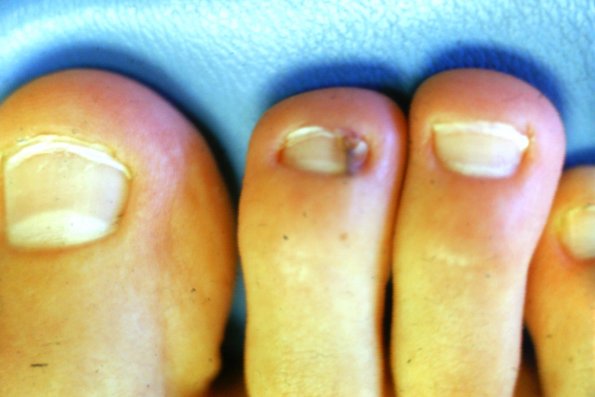 Toenail Nevus