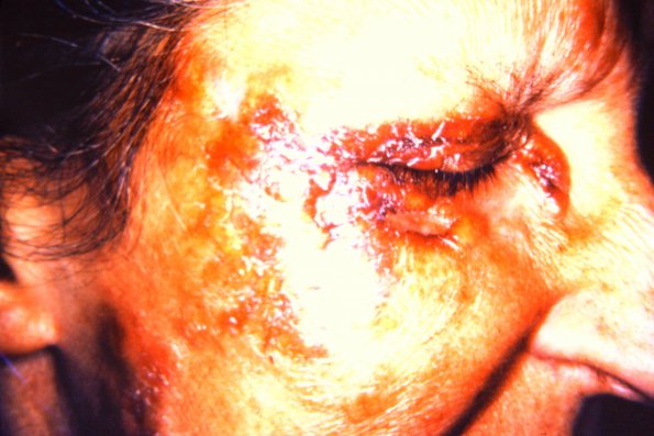 Necrobiotic Xanthogranuloma