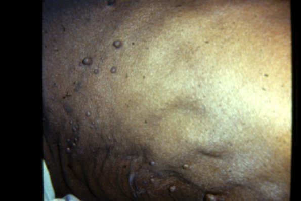 Neurofibromatosis