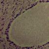 Neurofibrosarcoma (5)