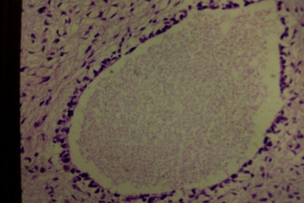 Neurofibrosarcoma (5)