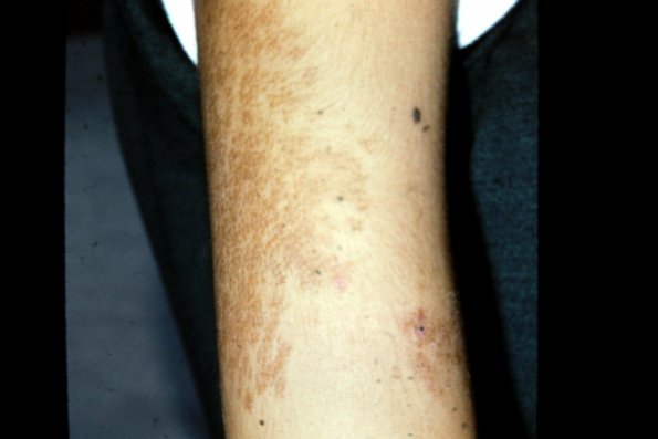 Becker's Nevus