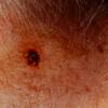 Blue Nevus (4)