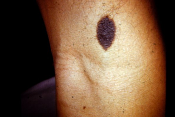 Congenital Hairy Nevus (2)