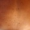 Dysplastic Nevus