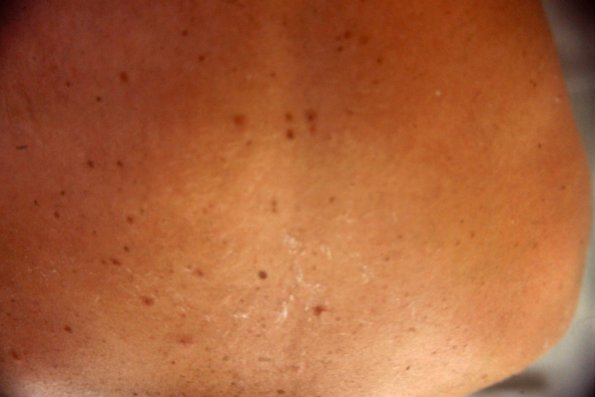 Dysplastic Nevus