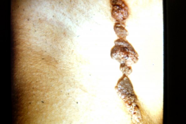 Epidermal Nevus (3)