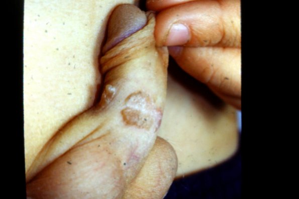 Epidermal Nevus