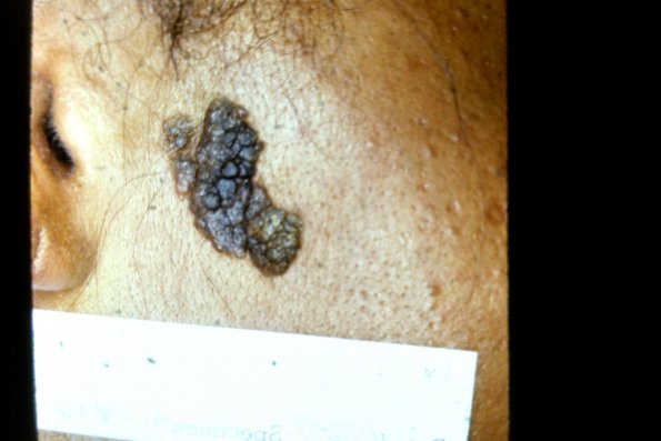 Verrucous Epidermal Nevus (5)