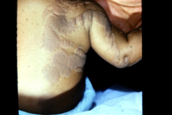 Verucous Epidermal Nevus