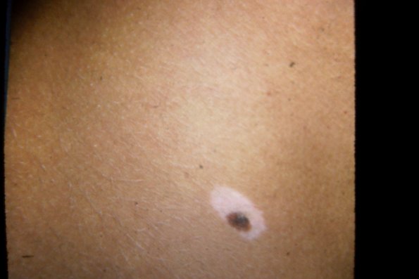 Halo Nevus (2)