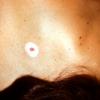 Halo Nevus (3)