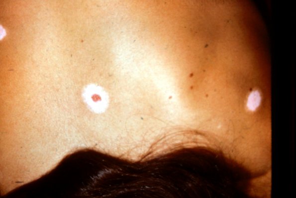 Halo Nevus (3)