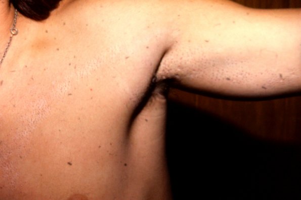 Nevus Comedonicus (2)