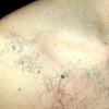 Nevus Comedonicus (4)